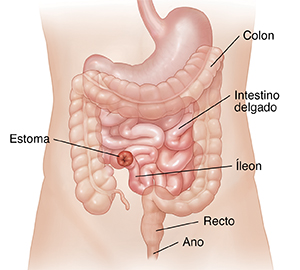 Parte anterior del abdomen donde puede verse una ileostomía terminal.