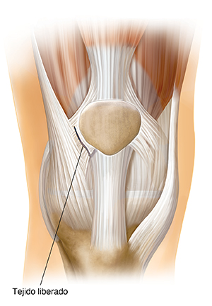 Vista frontal de la articulación de la rodilla que muestra la liberación del retináculo lateral.