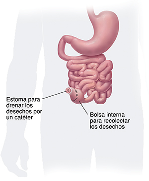 Vista frontal del tracto digestivo inferior donde se observa la extracción del colon y el recto, y la estoma y la bolsa de una ileostomía continente.