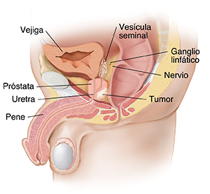 Vista lateral de los órganos pélvicos masculinos en la que se ve un tumor en la próstata.