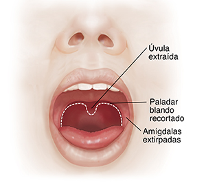 Vista frontal de una cara donde se observa la boca abierta. La línea de puntos muestra los tejidos del paladar blando que se extraerán.