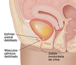 Primer plano de un corte transversal de la pelvis femenina con incontinencia urinaria de esfuerzo.