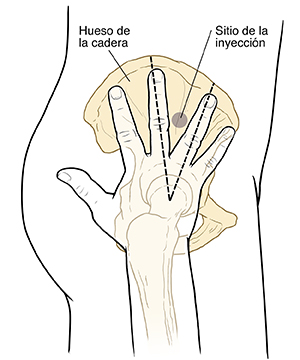 Contorno de la vista lateral de la parte inferior del cuerpo, la cadera y el muslo que muestra los huesos de la pelvis y la pierna. Mano con los dedos extendidos y la palma hacia abajo donde el hueso de la pierna se une con la cadera. Línea de puntos que encierra un círculo entre dos dedos medios.