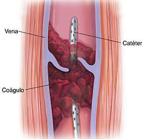 Corte transversal de músculo y vena varicosa con coágulo sanguíneo. Se ve un catéter insertado en la vena a través del coágulo sanguíneo.