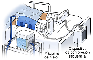 Paciente en la cama del hospital con un manguito alrededor de la rodilla conectado a una máquina de hielo y mangas de compresión secuencial en los pies y las pantorrillas.