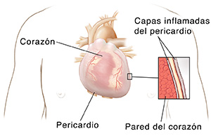 Vista frontal del pecho de un hombre donde pueden verse el corazón y los pulmones con un recuadro que muestra el pericardio. 