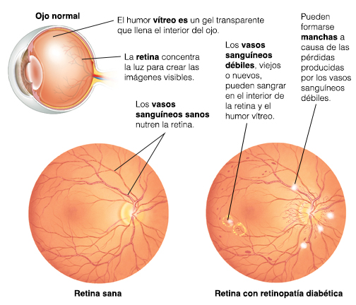 Corte transversal de un ojo donde pueden verse el humor vítreo y la retina. Vista frontal de una retina saludable en donde se ven los vasos sanguíneos. Vista frontal de una retina con retinopatía diabética.