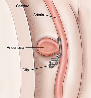 Primer plano de una arteria pequeña donde se muestra el pinzado de un aneurisma.