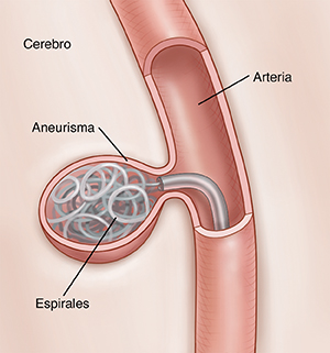 Primer plano de un corte transversal parcial de una arteria pequeña donde se muestra una espiral de alambre en un aneurisma.