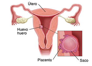 Corte transversal del aparato reproductor femenino con un recuadro donde se observa un embarazo anembrionado.